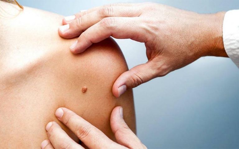 Cáncer de piel: Campaña de detección de manchas y lunares