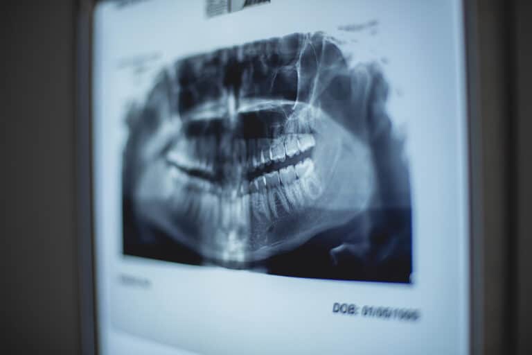 DESCUBREN UNA OPERACIÓN EN LA MANDÍBULA DE HACE 2.500 AÑOS