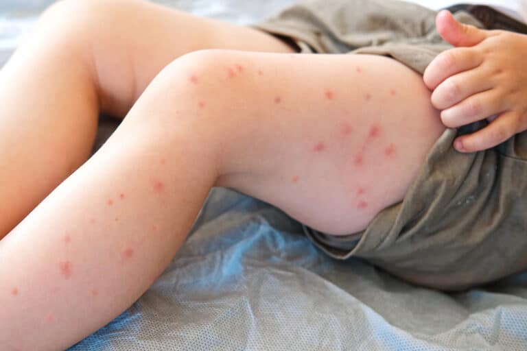 EL SARAMPIÓN SE EXPANDE EN EE. UU.